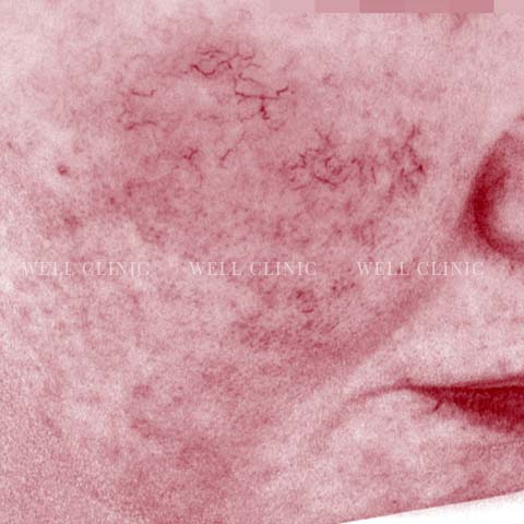 赤ら顔（毛細血管拡張症）解析画像